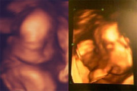 妊娠24週（3D画像）