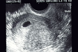 妊娠4週